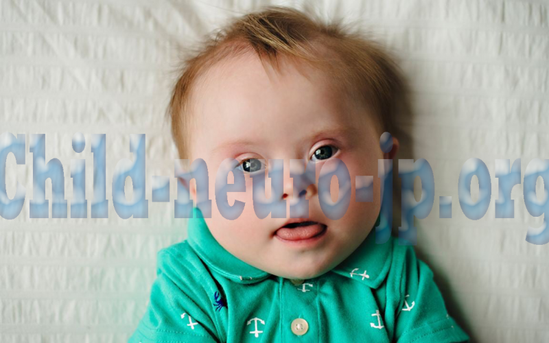 Neuro Ophthalmological Pada Anak Dengan Down Syndrome