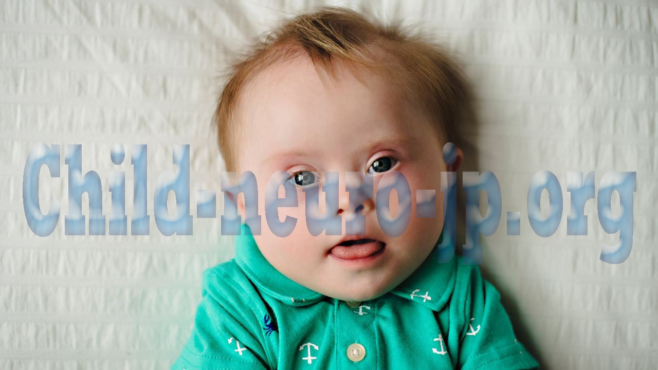 Neuro Ophthalmological Pada Anak Dengan Down Syndrome