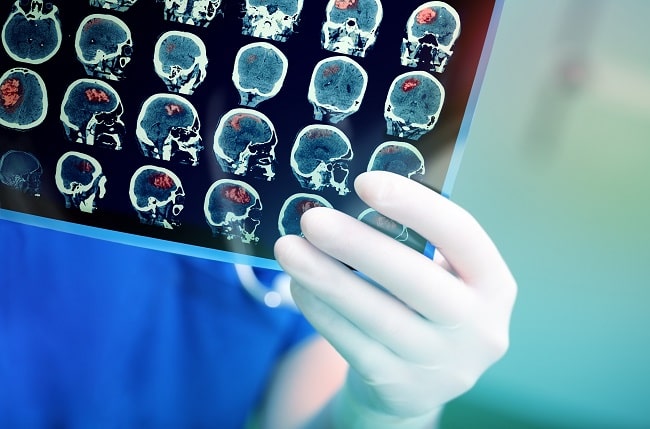 Komplikasi neurologis setelah perawatan anak-anak dengan tumor otak