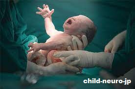 Kondisi Neurologis pada Bayi Baru Lahir